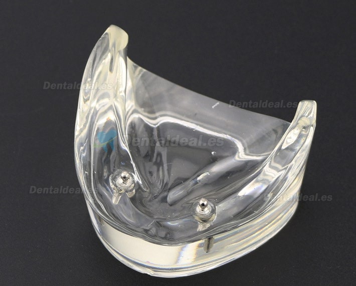 Dental Dientes inferiores Modelo de sobredentadura 2 Implantes Demostración Modelo 6002 01